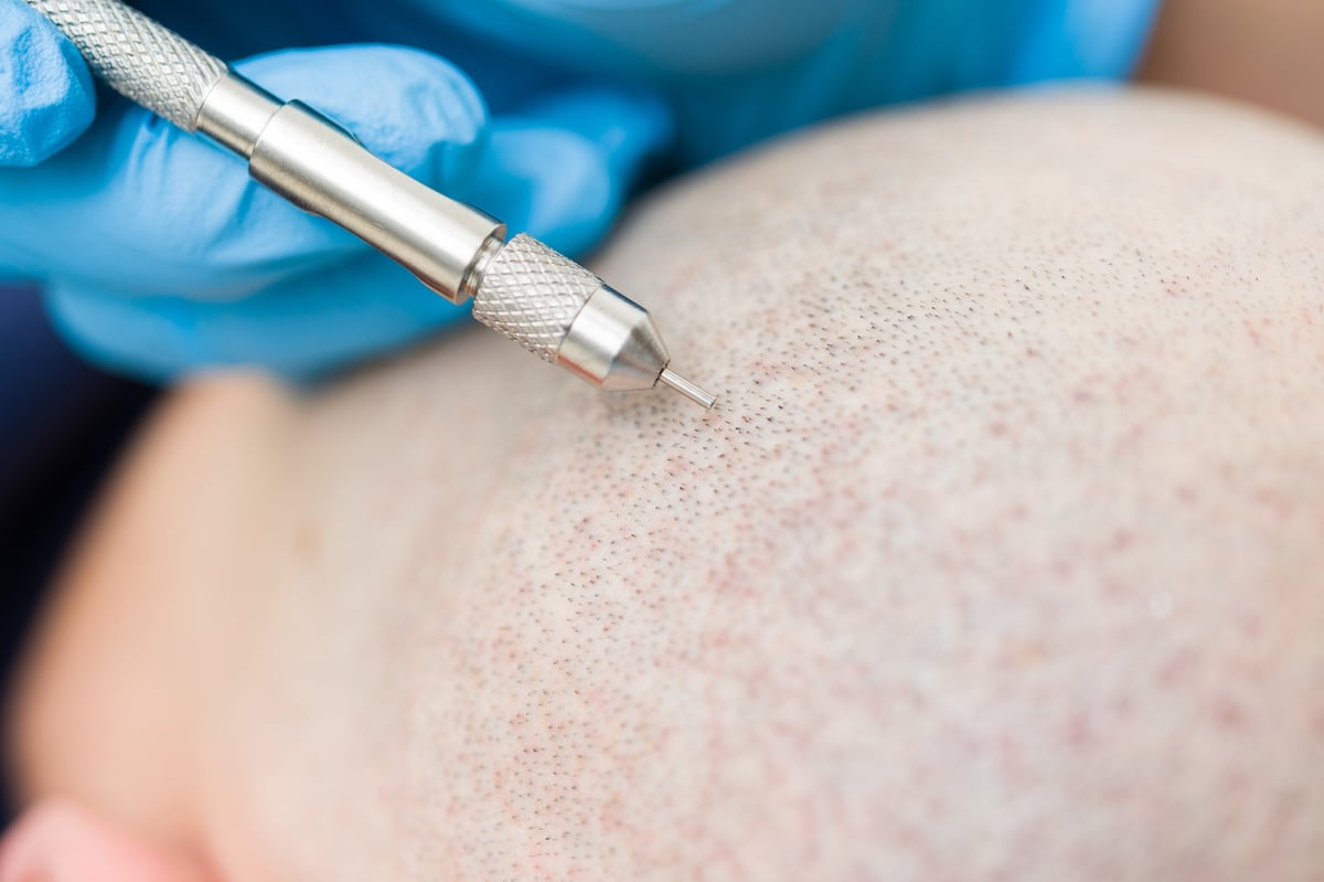 Profissional realizando procedimento de transplante capilar em paciente