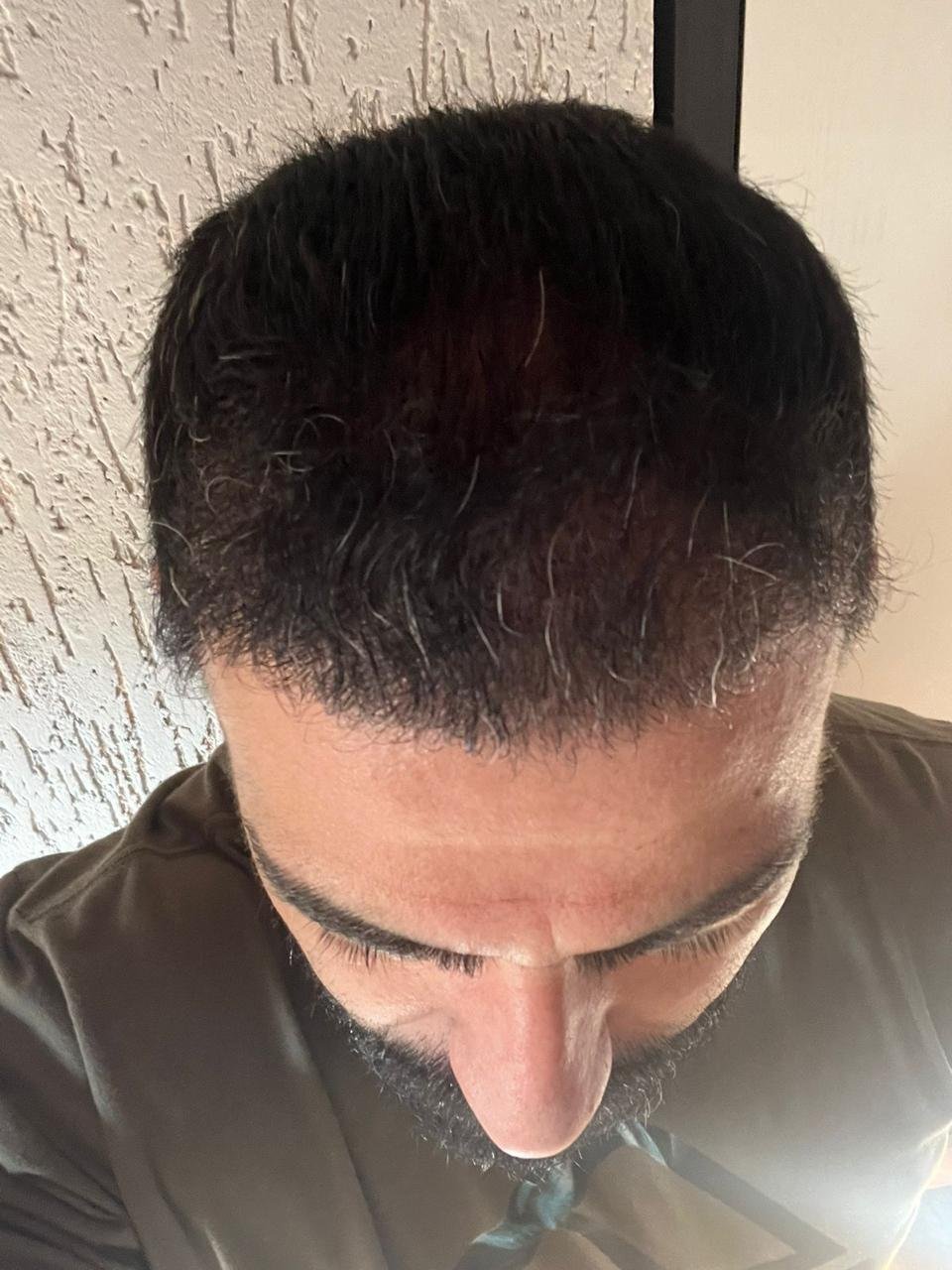 Resultado de transplante capilar em paciente do Instituto Pamplona, vista superior