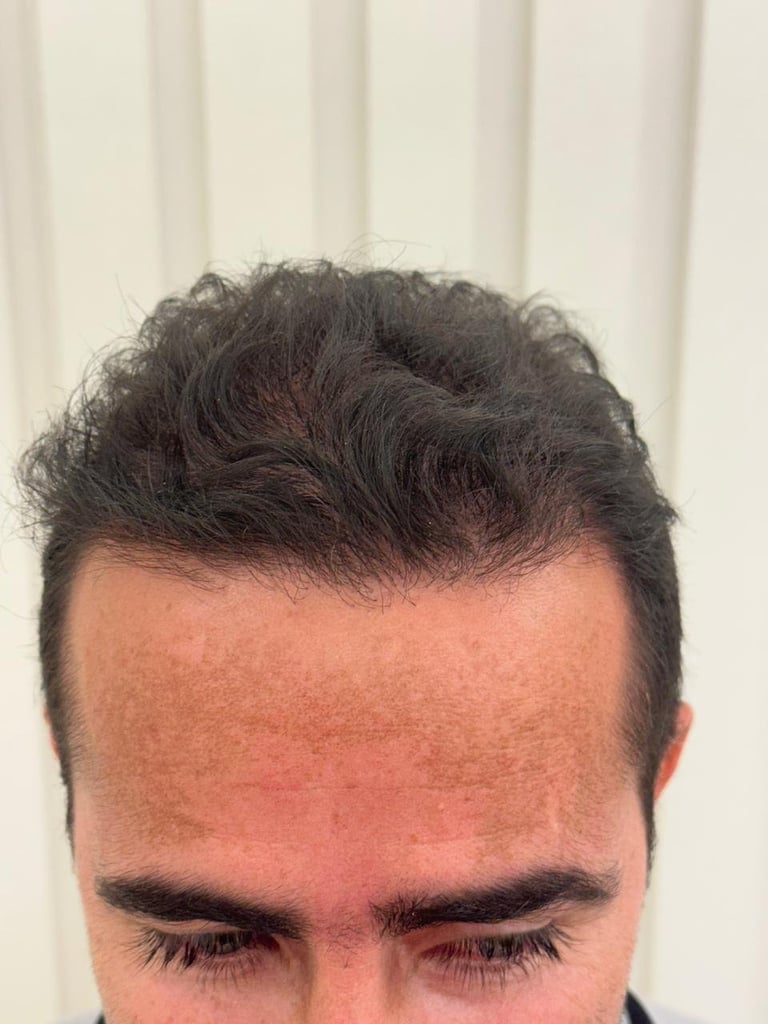 Detalhe da linha frontal redesenhada após transplante capilar